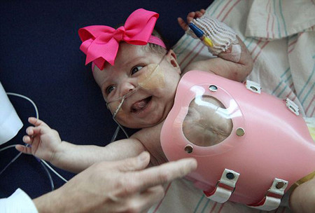 美女婴心脏长体外手术后平安出院